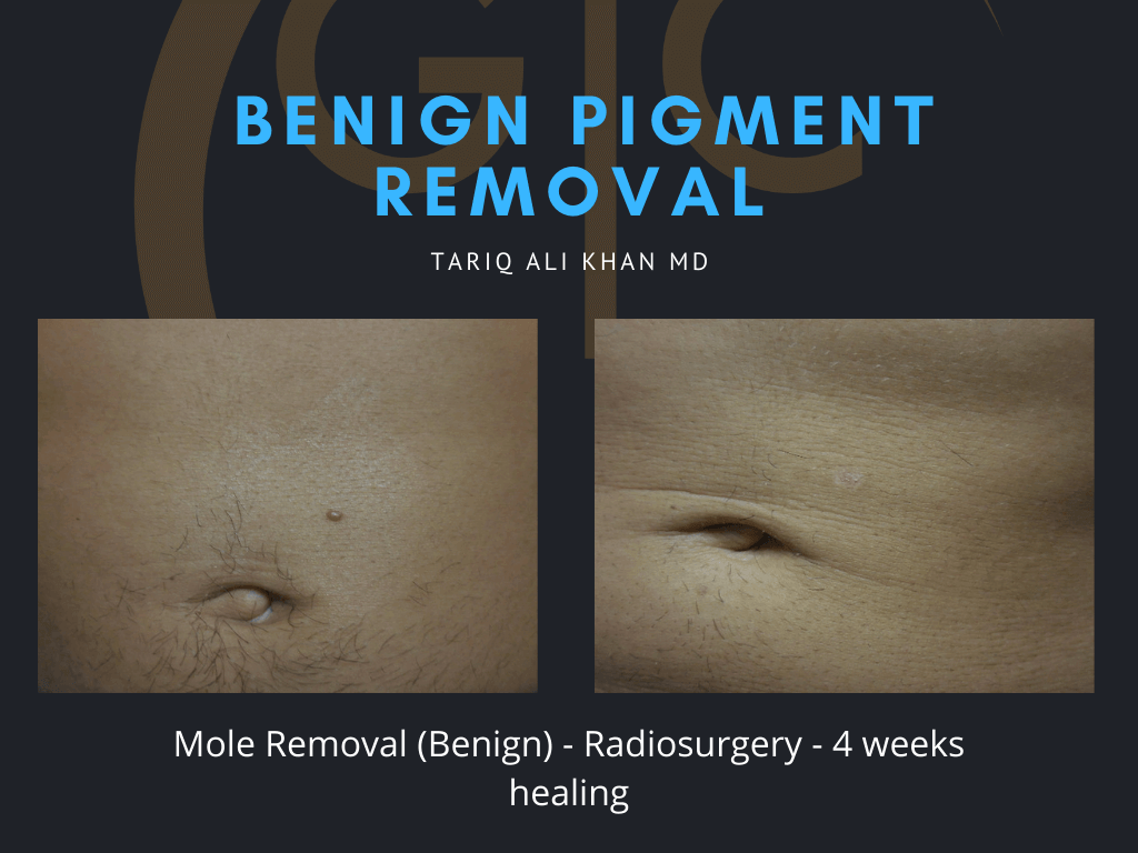 Gentle Care Laser Tustin & Long Beach Before and After picture - Mole Removal